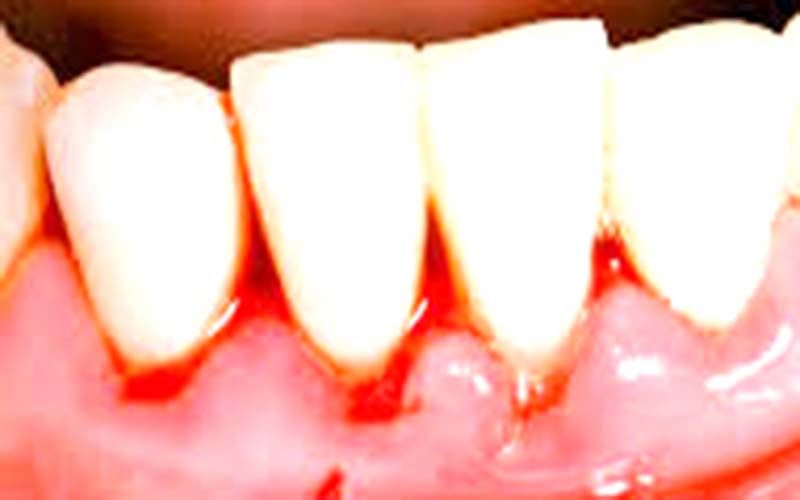Bleeding gums may indicate Vitamin C deficiency Greater Kashmir