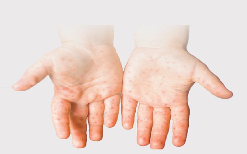 Hand, Foot, and Mouth Disease Outbreak HFMD Clinical features